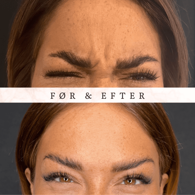botox bekymringsrynken