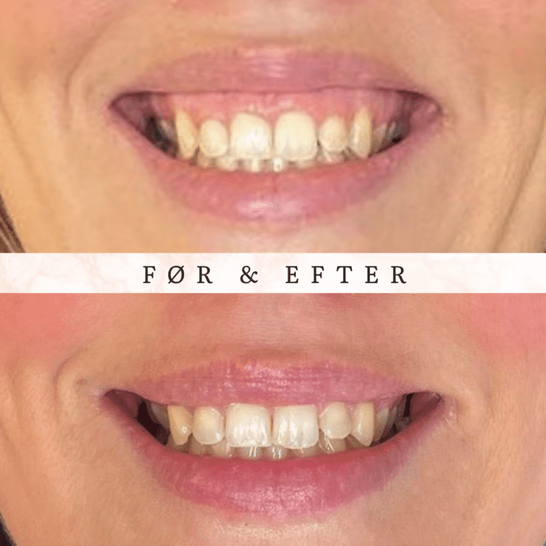 botox gummysmile østerbro