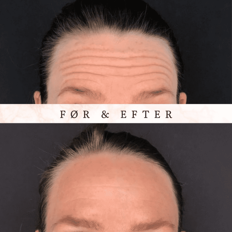botox pande rynker københavn